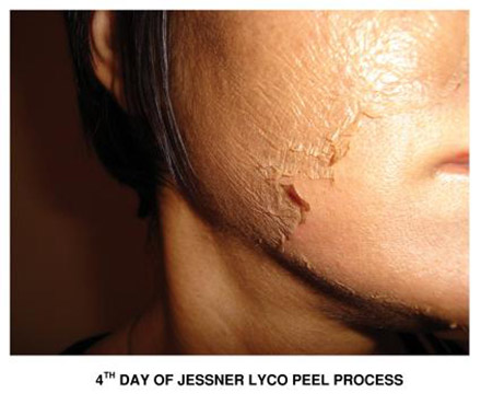 DMA Jessner peel treatment